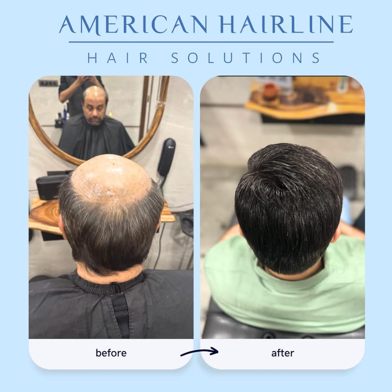Before-and-after hair restoration graphic with rear-view scalp photos
