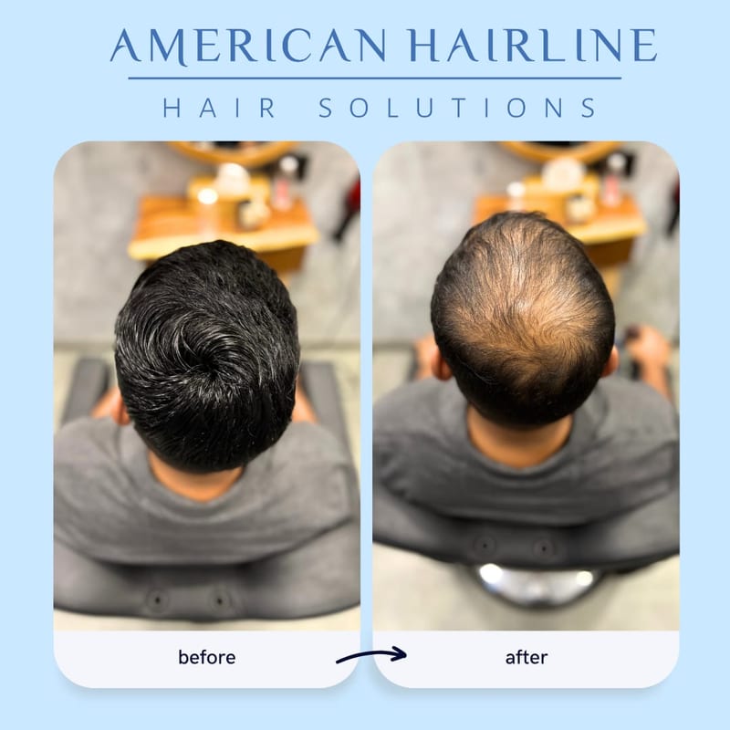 Before-and-after hair coverage comparison from above by American Hairline