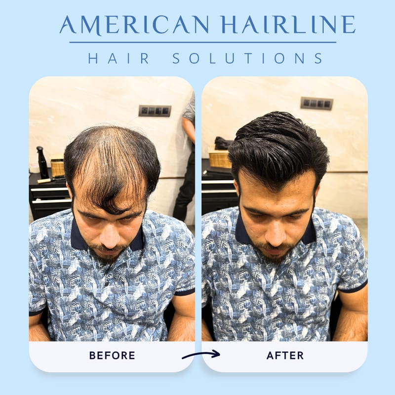 Before-and-after transformation of a man's thinning and styled hair