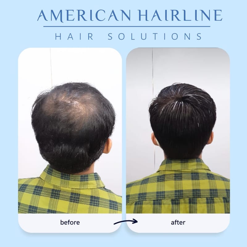 Before-and-after graphic of thinning and fuller dark hair by American Hairline